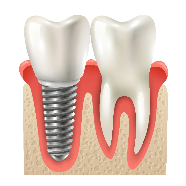 dental implant