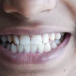 Ozempic teeth patient smiling during a dental checkup in Anaheim