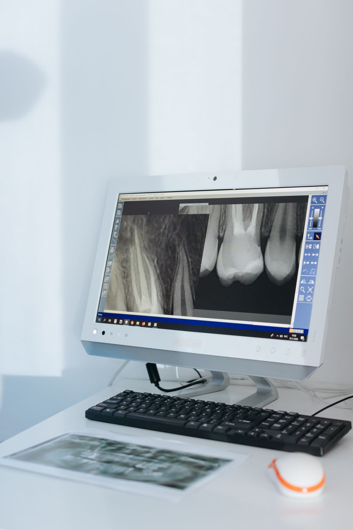 Cracked Tooth: Signs, Causes, and How Dentists Fix It 2 Dental X-ray of teeth displayed on a monitor in a dental office